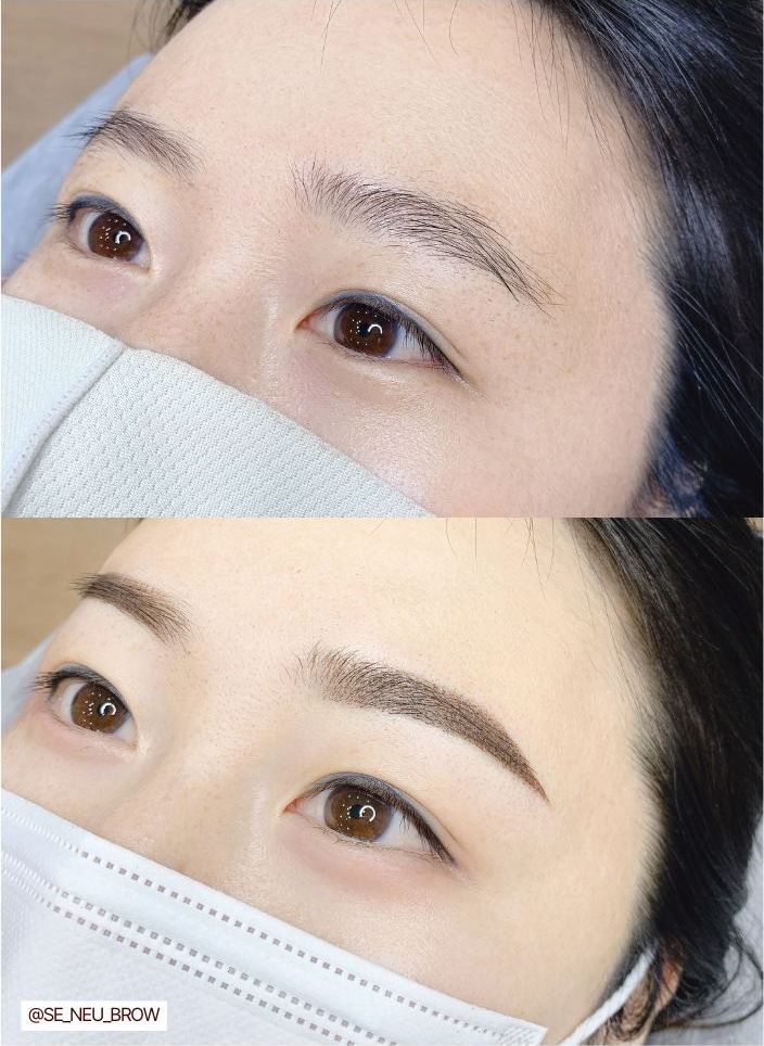 시술 전후 비교 3