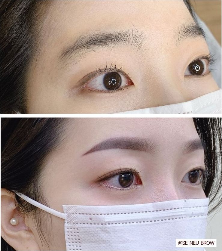 시술 전후 비교 6