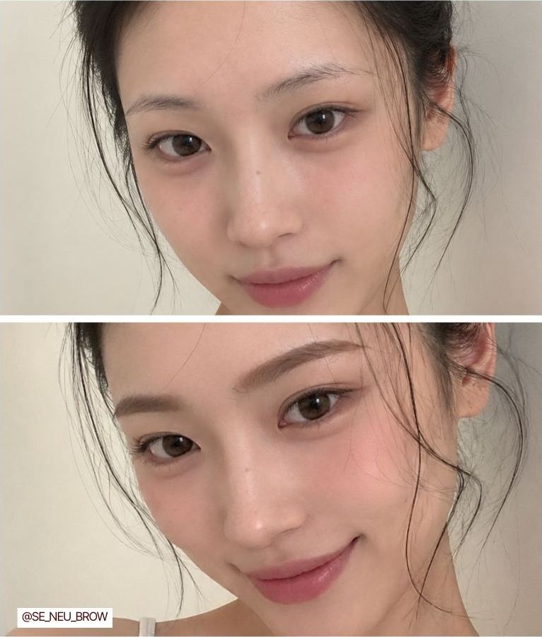 시술 전후 비교 14